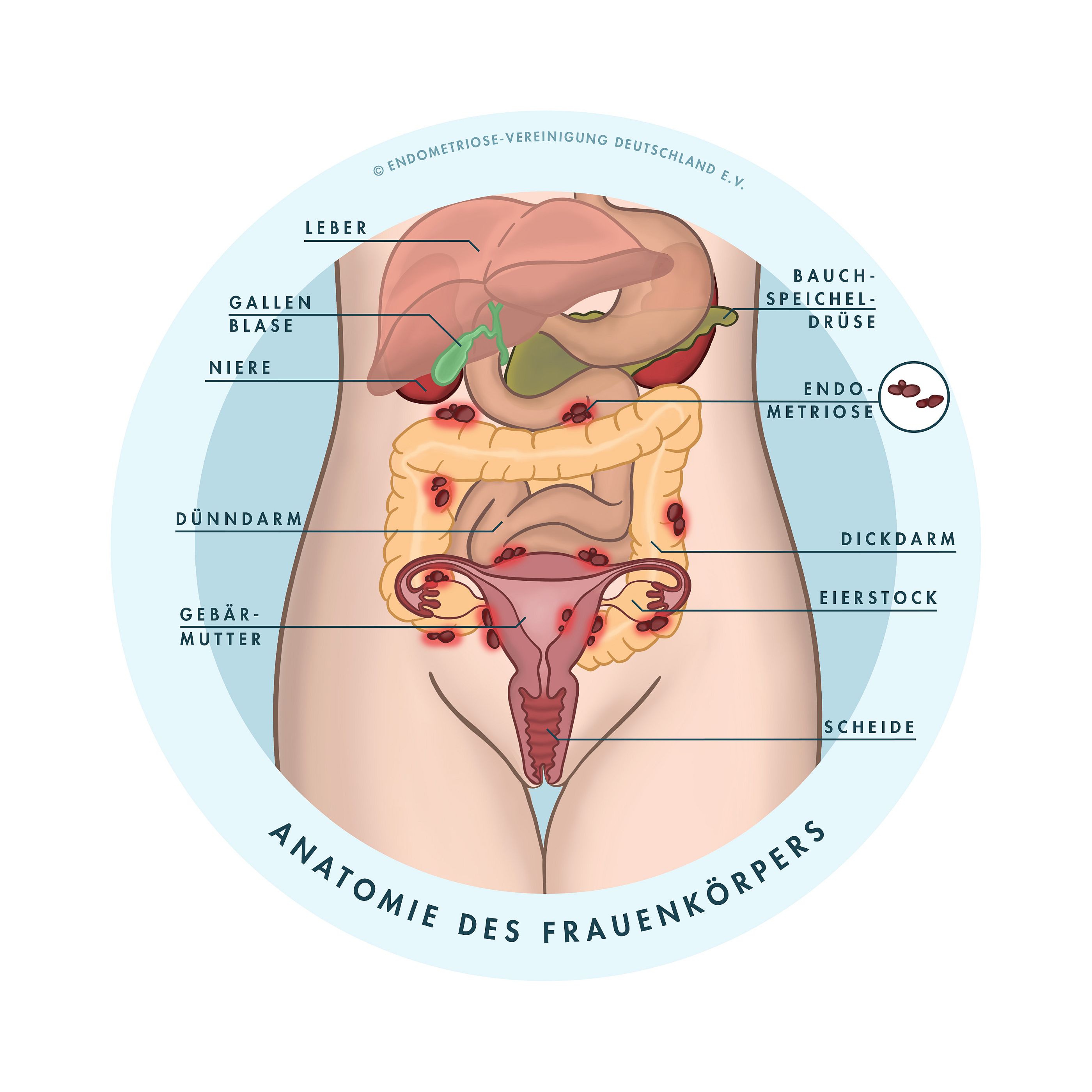 Schematische Darstellung der Lokalisation von Endometrioseherden